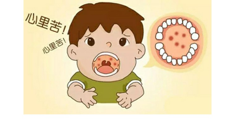 皰疹性咽峽炎高發(fā)，這些知識要了解！